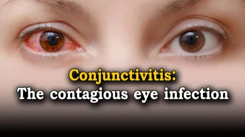 eye infection: redness, itching, tearing, and sensitivity to light."