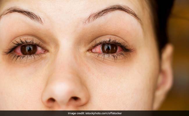  symptoms of an eye infection